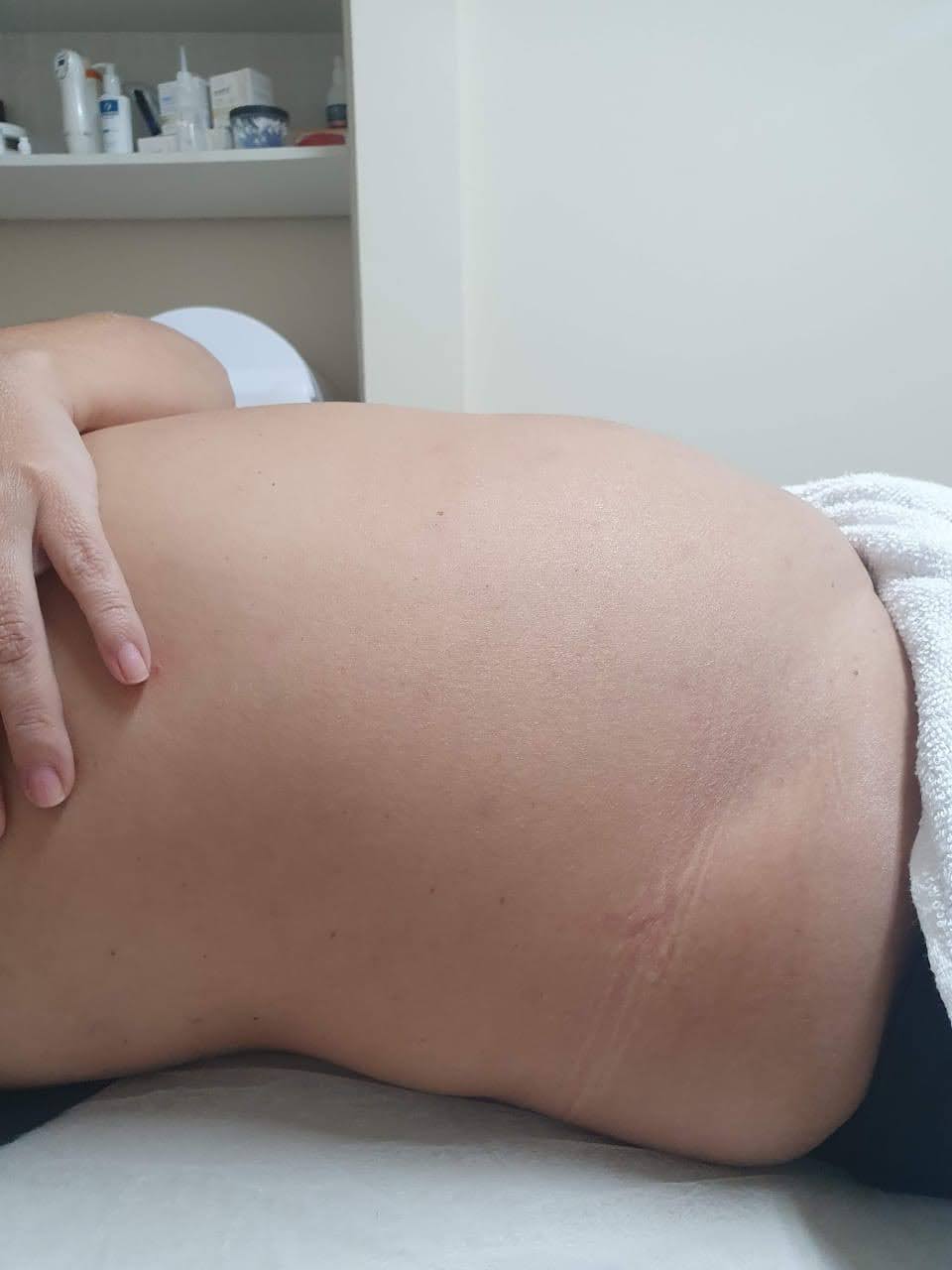 Antes do tratamento com enzimas para gordura localizada