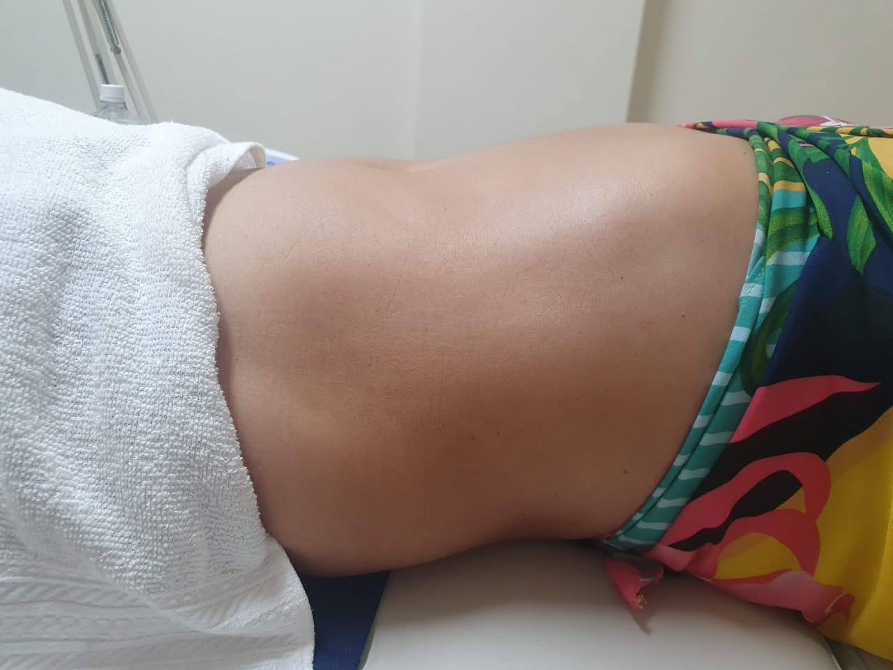 Depois do tratamento com enzimas para gordura localizada
